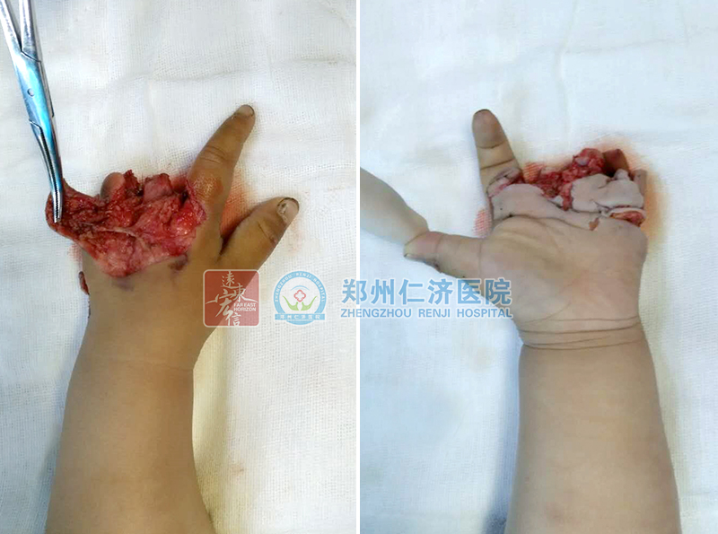 (术中:术中进行清创缝合修复受损血管神经肌腱 )