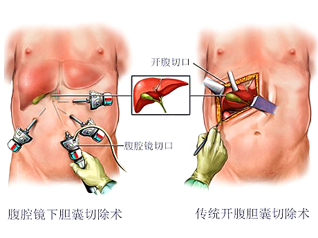 我院急诊科独立完成腹腔镜胆囊切除术