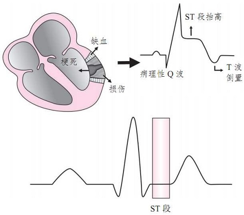 心电图机怎么设置打印心电图的意义_https://www.jmylbn.com_新闻资讯_第1张