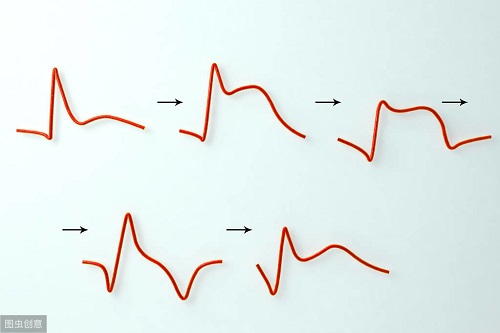 心电图机怎么设置打印心电图的意义_https://www.jmylbn.com_新闻资讯_第2张